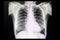 Chest film of a patient with lung nodule