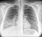 Chest Medical Xray, Lungs and Heart View