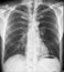 Chest Medical Xray, Lungs and Heart View