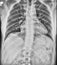 Chest Medical Xray, Lungs and Heart View