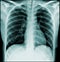 Chest x-ray