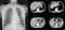 Chest x-ray and CT Chest thorax Moderate proximal dialtation of esophagus with tertiary peristalsisA 3cm pleural base nodule at Lt