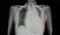 chest x-ray film of a patient with cardiomegaly