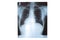 A chest x-ray film of a patient. Medical Education. Abnormal xray in lung infections. Covid 19 pneumonia