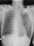 Chest x-ray finding Interstitial pulmonary infiltration both lungs and Normal heart size and bony thorax.Medical healthcare