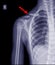 Chest x-ray fracture right clavicle
