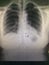 Chest X-ray graphy