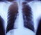 Chest X ray image of healthy man