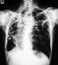 Chest X-ray image, PA upright view.