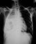 Chest X-ray image, PA upright view.