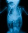 Chest X-ray include abdomen.