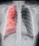 Chest X-ray with Lung 3D rendering image .
