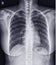 Chest x-ray normal,medical concept.