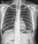 Chest x-ray normal,medical concept.