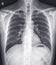 Chest x-ray normal,medical concept.