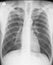 Chest X-ray. Posteroanterior view. Two years after spontaneous pneumothorax.