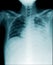 Chest x-ray show many secretion in lower lobe and middle lobe of lung