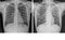 Chest x-ray Showing Normal chest and Pulmonary Tuberculosis TB