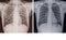 Chest x-ray Showing Normal chest and Pulmonary Tuberculosis TB