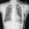 Chest X-ray shows subcutaneous emphysema at left chest wall and left lower cervical region.