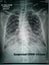 Chest X-Ray of suspected Corona virus patient high quality image showing changes in the lung due to Covid-19 virus with chest tube