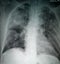 Chest X-Ray of suspected Corona virus patient high quality image showing changes in the lung due to Covid-19 virus with chest tube