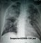 Chest X-Ray of suspected Corona virus patient high quality image showing changes in the lung due to Covid-19 virus with chest tube