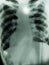 Chest x-rays show advanced pulmonary tuberculosis.