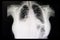 A chest xray film of a patient with cadiomegaly and pleural effusion