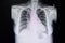 chest xray film of a patient with double lumen catheter