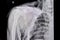 Chest xray film of a patient with fracture of left clavicle, ribs 2rd to 7th, fracture scapular, hemothorax, and subcutaneous