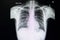 A chest xray film of a patient with  pneumonia