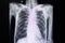 chest xray of a patient with pulmonary emphysema