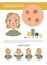 Chicckenpox infographic