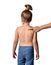 Chickenpox disease pimples on baby girl back and shoulders. Chicken pox virus outbreak in children. Concept of contagion