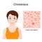 Chickenpox. Varicella. face of a child with skin rash