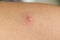 Chickenpox varicella on the skin