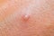 Chickenpox varicella on the skin