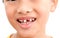 Child broken tooth