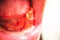 Child caries, Close-up shots of decayed tooth child., Stacked front tooth, a problem with children.