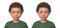 A child with esotropia and the same healthy man, 3D illustration