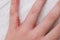 Child hand witn eczema, atopic dermatitis between fingers