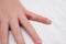 Child hand witn eczema, atopic dermatitis between fingers