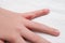 Child hand witn eczema, atopic dermatitis between fingers