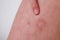 The child has allergic contact dermatitis on the skin