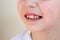 Child has crooked teeth. The concept of crowding of molars