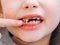 The child has a milk tooth and a new adult curve tooth. Open mouth with finger. Treatment and care milk teeth in children