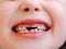 The child has a milk tooth and a new adult curve tooth. Treatment and care milk teeth in children