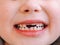 The child has a milk tooth and a new adult curve tooth. Treatment and care milk teeth in children