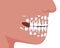 A child with a jaw with milk teeth, a flat stock vector illustration with molars and incisors as a concept of changing milk teeth